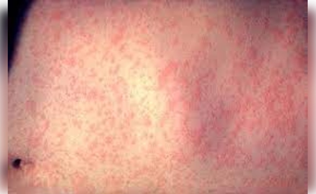 Measles outbreak spreads in US