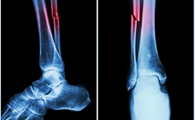 Covid can cause bone loss, higher fracture risk: Study