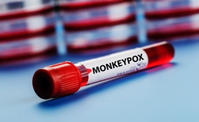 Man with monkeypox-like symptoms admitted to Hyd hospital