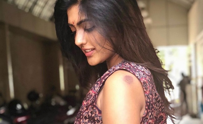 Eesha Rebba Reveals Her 'hurt' Mark on Shoulder!